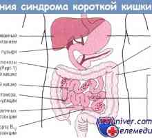 Ефект на синдром на кратко црево (ЗКК) на гастроинтестиналниот тракт