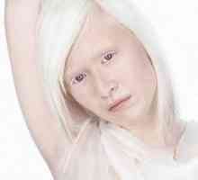 Албинизмот кај луѓето, око