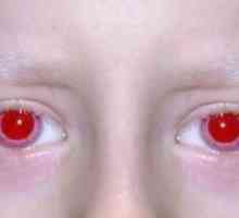 Албинизмот кај луѓето: симптоми, причини, симптоми, третманот
