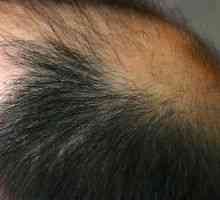 Алопеција коса: Третман, Причини, Симптоми, знаци