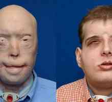 Американски хирурзи се трансплантирани лице јагленисано пожарникар