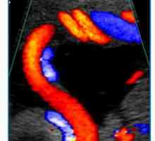 Аномалии на срцето, аортата и пулмоналната багажникот на фетусот. Доплер феталните срцеви аномалии