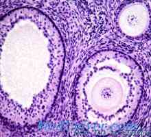 Arrhenoma на јајниците хистологија, патолошка анатомија