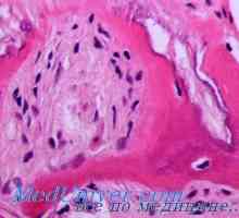 Атеросклероза во позадина на инсулинска резистенција. Метаболизмот на мастите во дијабетес и…