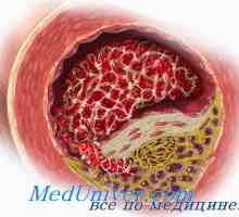 Атеросклероза во менопауза и менопауза. Ефектот на тестостерон на артериосклероза андрогени