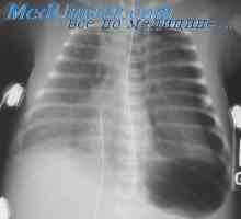 Баротраума белите дробови за време на декомпресија. Патогенезата на пулмонална баротраума