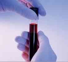 Биохемиска анализа на крвта за панкреатитис