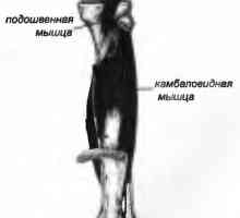 Болки во грбот предизвикани од страна на мускулите на soleus