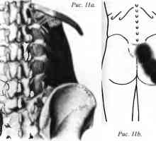 Болки во грбот предизвикани quadratus lumborum
