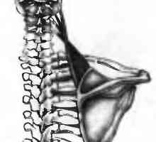 Болки во грбот предизвикани од страна на мускулите levator скапула