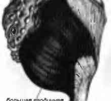 Болки во грбот предизвикани од страна на gluteus maximus