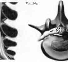 Болки во грбот herniated јадро pulposus (диск хернија)