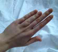Брахидактилија палецот: причини, третман, симптоми, знаци