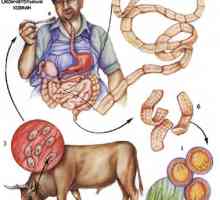 Говеда (невооружени) говедско тенија тенија инфекција кај луѓето