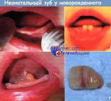 Неонатален заб новороденче причини, дијагноза