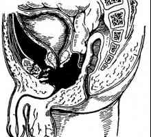 Cimptomy и дијагностика povrezhdeniq карлицата и карличните органи. Спротивно на радиографија