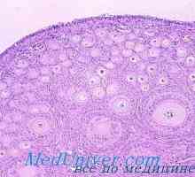 Meristoma јајниците. Tekakletochnaya тумор Tecoma