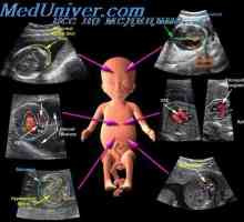 Колор доплер сонографија со моларна бременост. Боја мапирање на фетусот садови