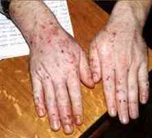 CYP панкреатитис, осип на кожата заболување на панкреасот