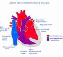Вентрикуларен септален дефект на срцето: причините, третман, симптоми, знаци