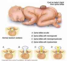Дефекти на невралната туба кај деца: енцефалоцела, meningomyelocoele