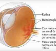 Nonproliferative дијабетична ретинопатија и дијабетска ретинопатија (npdr)