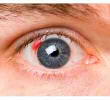 Дијабетична ретинопатија: симптоми, третманот, фаза, компликации