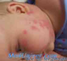Дијагноза на алергија и други несакани ефекти на лекови кај децата