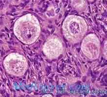 Disgerminoma семином или јајниците. оваријални тумори Lipoidnokletochnye virilizing