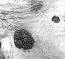 Бенигни тумори на кожата, главата и вратот: пигментирани nevus