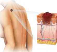 Бенигни тумори на кожата: видови, класификација, третман, симптомите