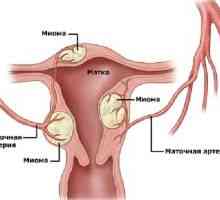 Матката fibroids, третман, симптоми, знаци, причини