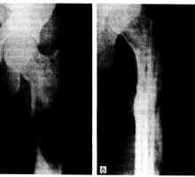 Фиброзна дисплазија на коските (Braitseva болест)