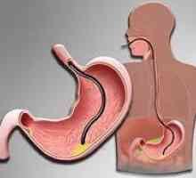 Формирање на полип на желудникот