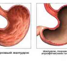 Гастритис и рак на желудник