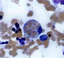 Hemophagocytic лимфохистиоцитоза: третман, предизвикува, прогноза