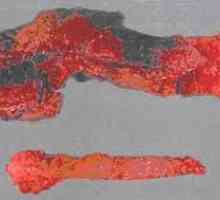 Хеморагичен некротизирачки панкреатит и акутна форма