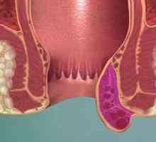 Hemorrhoidal тромбоза: фаза, симптоми и третмани