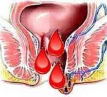 Хемороиди за време на менструацијата, зошто се влошува пред нив?