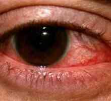 Херпетичен кератитис око: третман, превенција, симптоми, причини