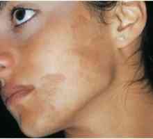 Хиперпигментација на кожата: третман, причините, превенција