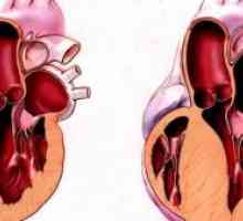Хипертрофична кардиомиопатија: Третман, симптомите