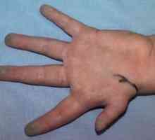 Хипоплазија на првиот прсти