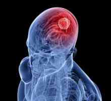 Мозокот глиома: третман, прогнозата симптоми, знаци
