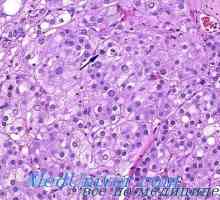 Gormonalnoaktivnye кортекс тумор на надбубрежната