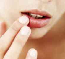 Хелитис на усните, третман, симптоми, причини