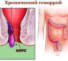 Хронична (постојан), внатрешните и надворешните хемороиди