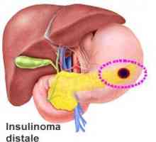 Инсулиномна на панкреасот