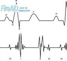 Срцеви тонови. Првиот (систолен) срцев тон. Вториот (дијастолен) срцев тон. Фонокардиограм.