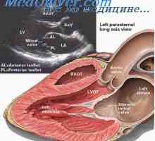 Хемодинамски нарушувања во срцеви мани, и физички напор